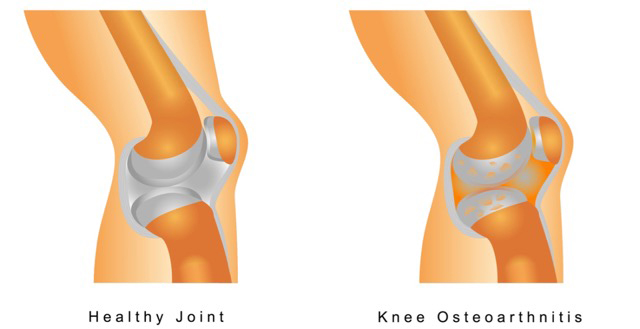 partial vs total knee replacement surgery