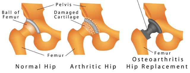 total hip replacement