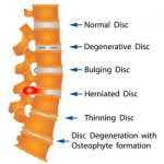 Herniated Disk