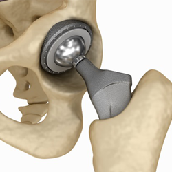 hip replacement