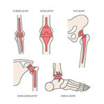 Elbow, knee, hip, shoulder, and ankle prostheses