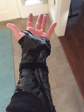 toms-wrist-fracture-img