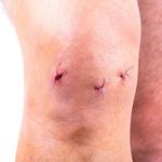 arthroscopic knee surgery